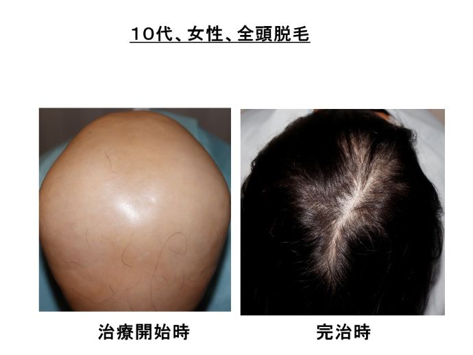 円形脱毛症　病院